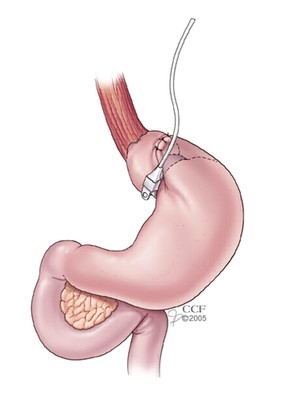 Adjustable Gastric Band