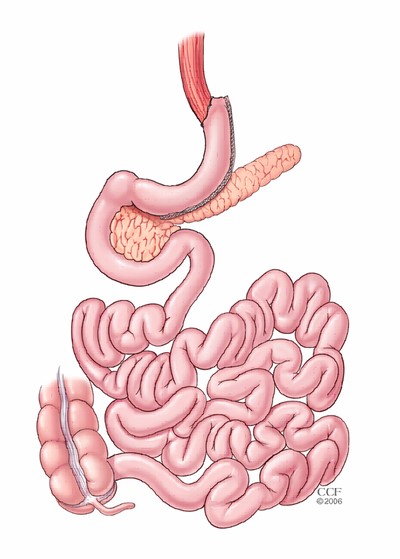 Sleeve Gastrectomy